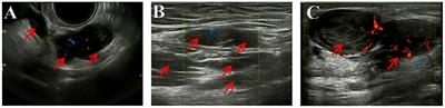 Concurrent Benign Metastasizing Leiomyoma in the Abdominal Wall and Pelvic Cavity: A Case Report and Review of the Literature